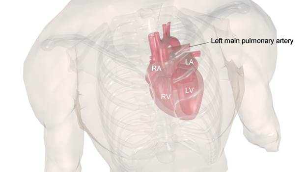 anatomy: left main pulmonary artery
